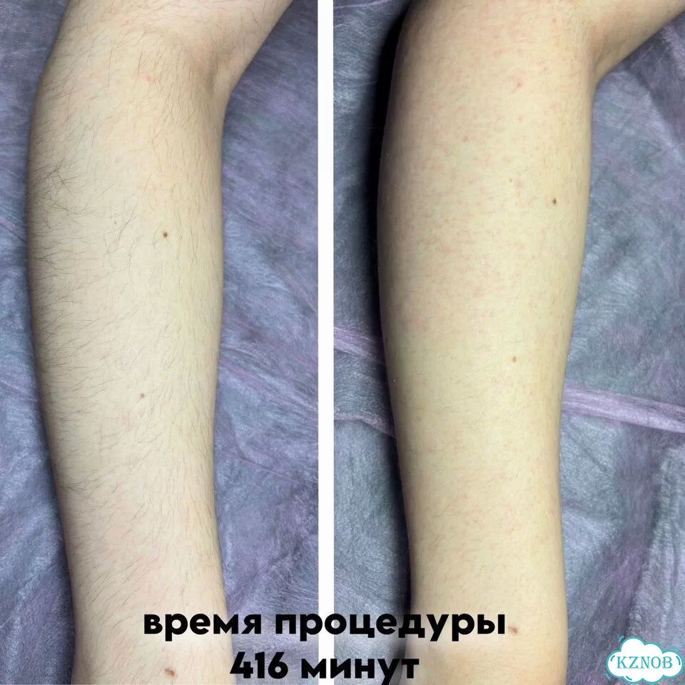 Модель на электроэпиляцию фото 4