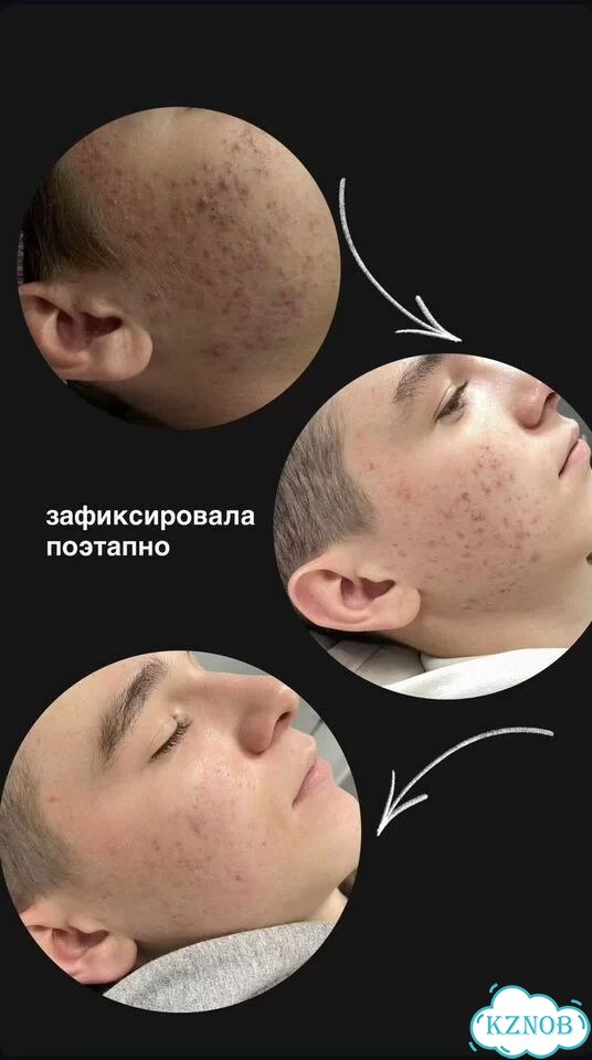 Чистка лица Прыщи Черные точки Акне фото 1